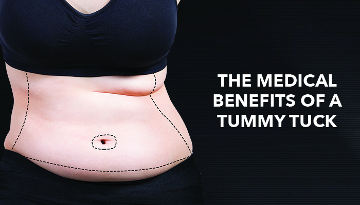 The Medical Benefits of a Tummy Tuck - Plastic Surgery Houston | Cosmetic  Surgeon & Dermatologist