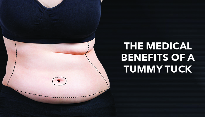 Tummy Tucks: Major Medical Benefit