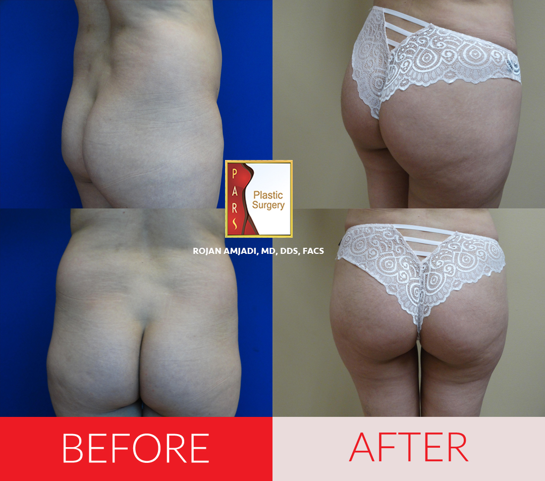 Buttock Lift with Augmentation Before and After Photos