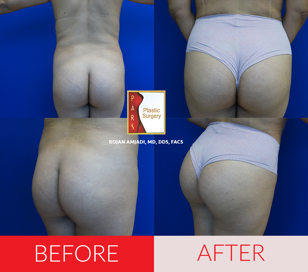 Buttock Implants Miami - Gluteoplasty