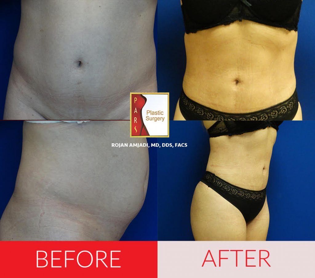 How Soon Can You Have Liposuction After Having a Baby? - Houston Lipo Center